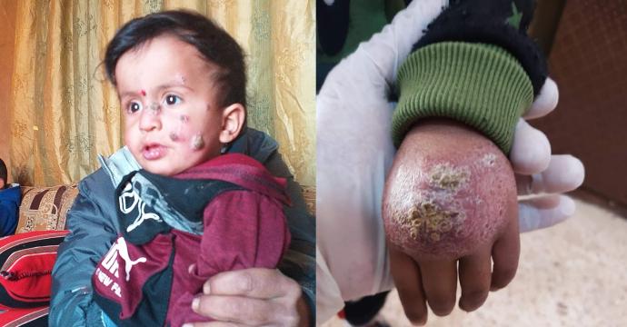 أطفال مصابين باللشمانيا في منطقة نبع السلام2.jpg