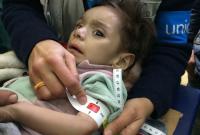 طفل سوري يعاني من سوء التغذية الحاد - يونيسف
