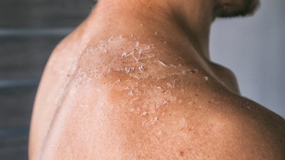 dry-itching-man-s-skin-after-sunbath_244784-469.jpeg